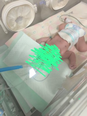 Lahir Tanpa Tempurung Kepala, Bayi di Palembang…